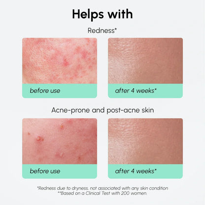 Redness Soothing Azelaic Acid Serum